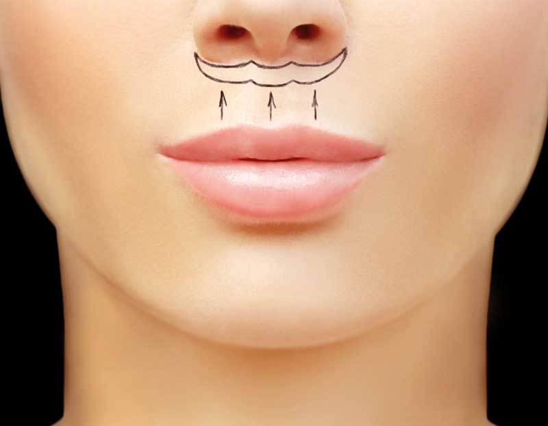 lip_surgery_before